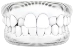 Invisalign<sup>®</sup> Treatment