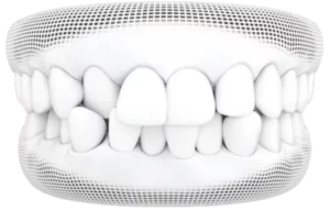 Invisalign<sup>®</sup> Treatment